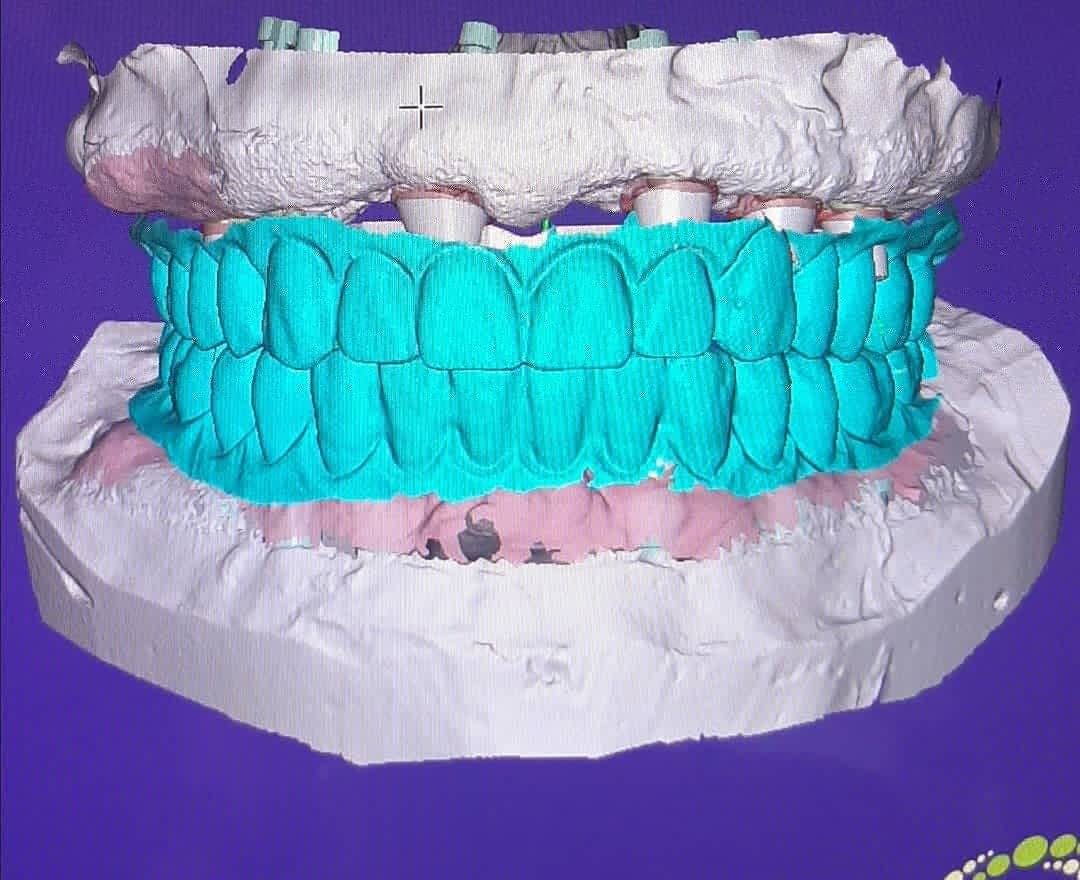 Tecnología CAD-CAM dental