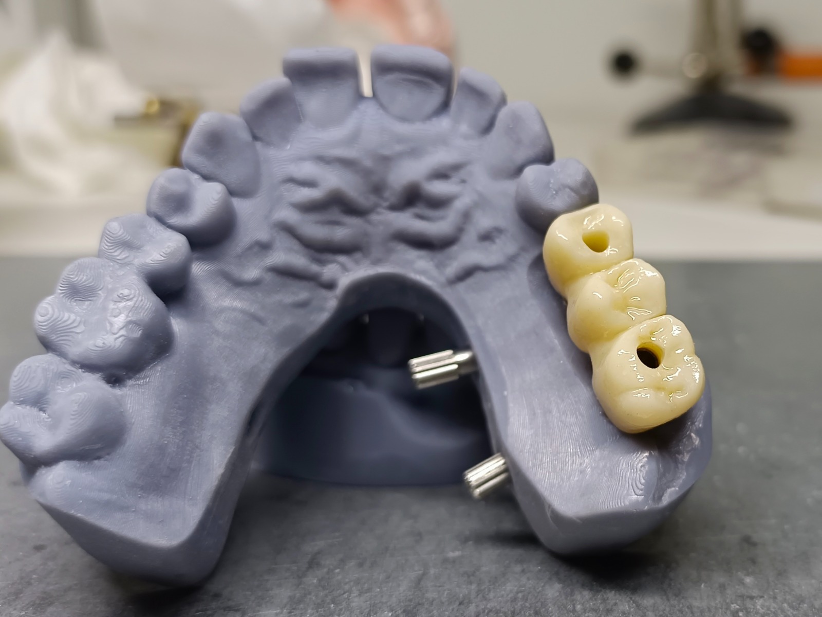 Implantes dentales